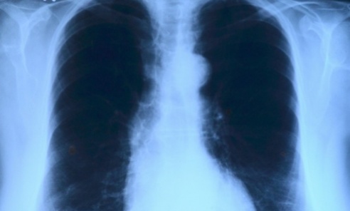Płuca zwykle dobrze się regenerują po COVID-19 - Serwis informacyjny z Wodzisławia Śląskiego - naszwodzislaw.com